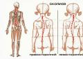 Signs and treatment of scoliotic postural disorder